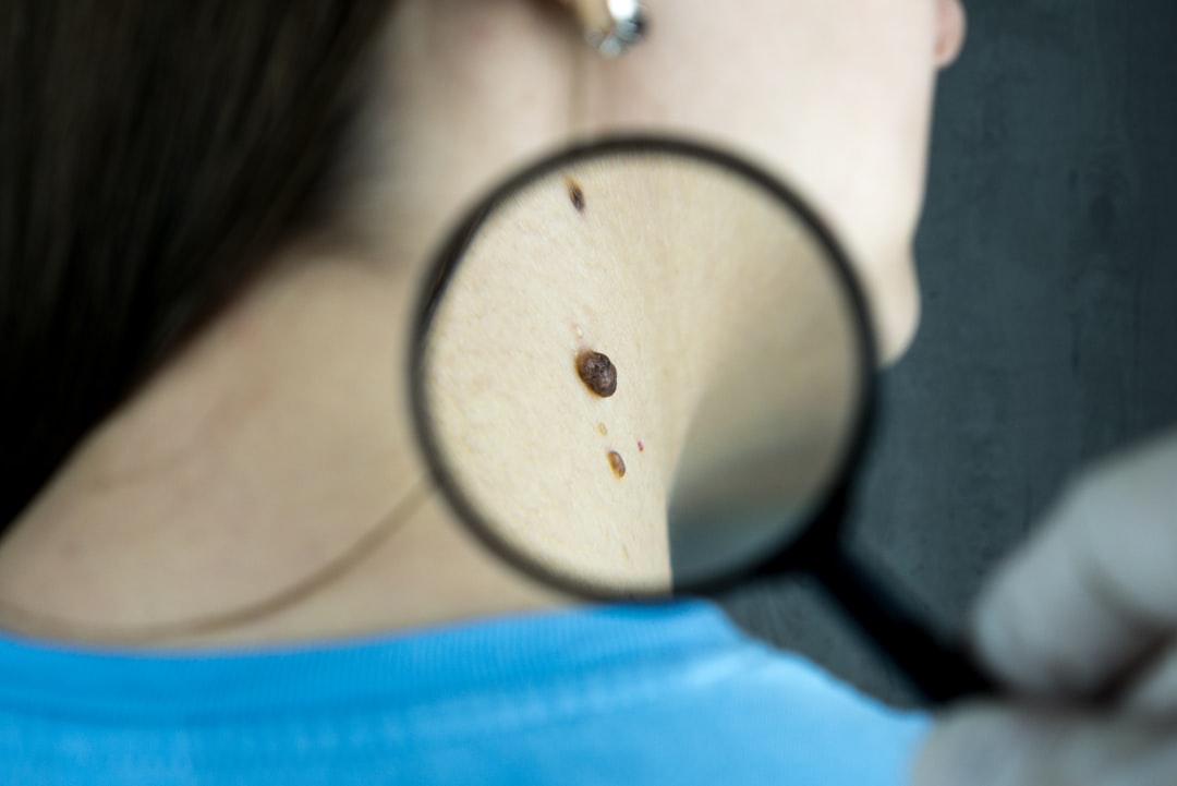 Photo Skin spots